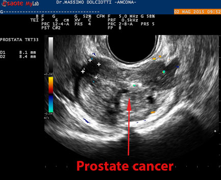 ecografia prostata valori normali
