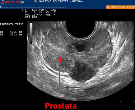 primariaviisoarabh.ro - Operatie De Prostata Prin Vaporizare