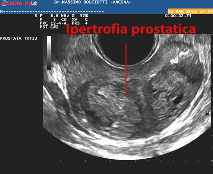 zona periferica prostata dishomogenea