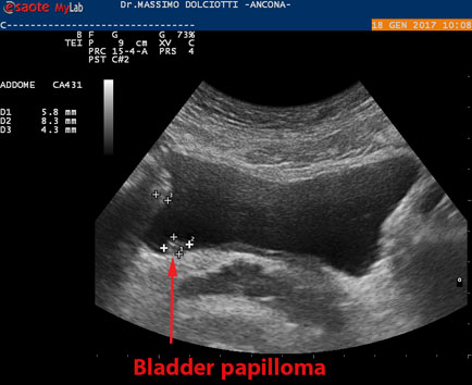 papilloma in vescica