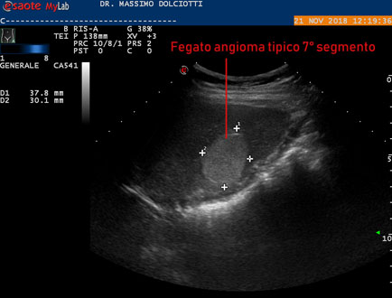 area iperecogena prostata)