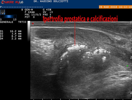 calcificazioni prostata)