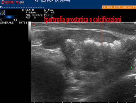 volume prostatico normale a 60 anni Gyertyák amikor krónikus prosztatitis