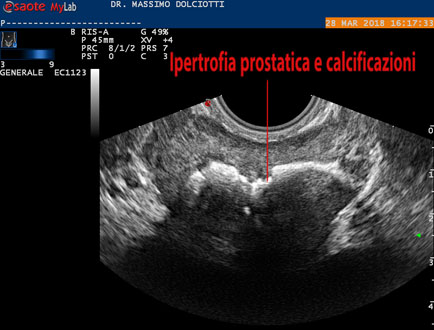 area ipoecogena prostatica Prostatitis a hatékonyságért