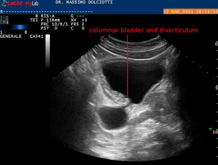 adenoma prostata ecografia)
